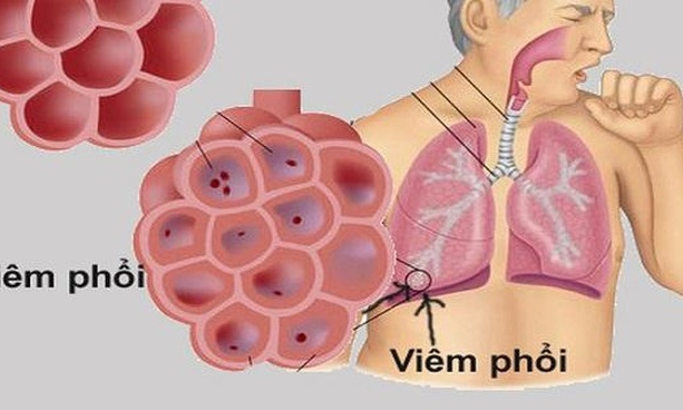 Cần làm gì phòng chống viêm phổi cấp do chủng vi rút mới