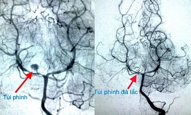 Cảnh giác dấu hiệu trẻ nhỏ thường nôn ói sau ăn, liệt dần một bên