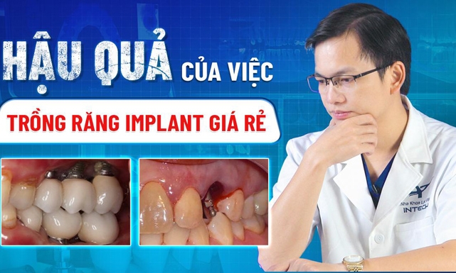 Hậu quả trồng răng Implant giá rẻ