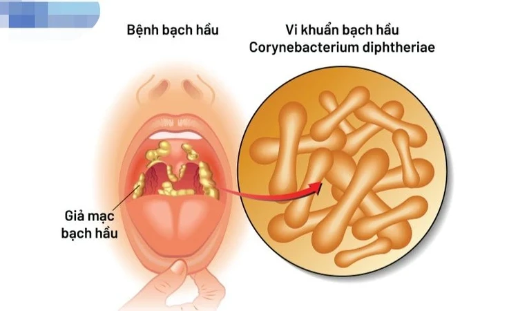 Cần lưu ý điểm gì khi trẻ mắc bệnh bạch hầu