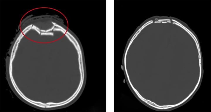 Hình ảnh vùng sọ não bị lún của trẻ trước và sau khi phẫu thuật (vùng khoanh tròn màu đỏ). (Ảnh: Bệnh viện Việt Nam - Thuỵ Điển Uông Bí)