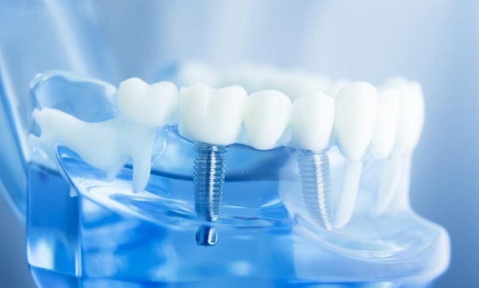 Trồng răng implant có tồn tại những nhược điểm nào?