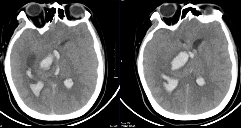Kết quả chụp lại phim MSCT mạch não chảy máu não đồi thị - não thất do vỡ khối AVM của bệnh nhân 15 tuổi.