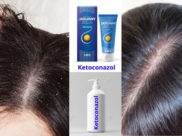 Dầu gội chứa ketoconazol giúp loại bỏ gàu hiệu quả.