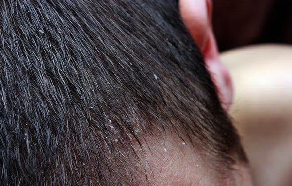 Tỷ lệ nam giới bị gàu cao hơn nữ giới.