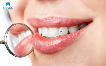 Răng được bọc sứ Diamond có độ sáng lấp lánh và bóng nhẹ như kim cương