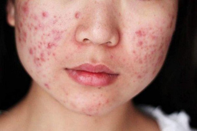 Da dị ứng, nổi mẩn đỏ do dùng mỹ phẩm không rõ nguồn gốc mua trên mạng.