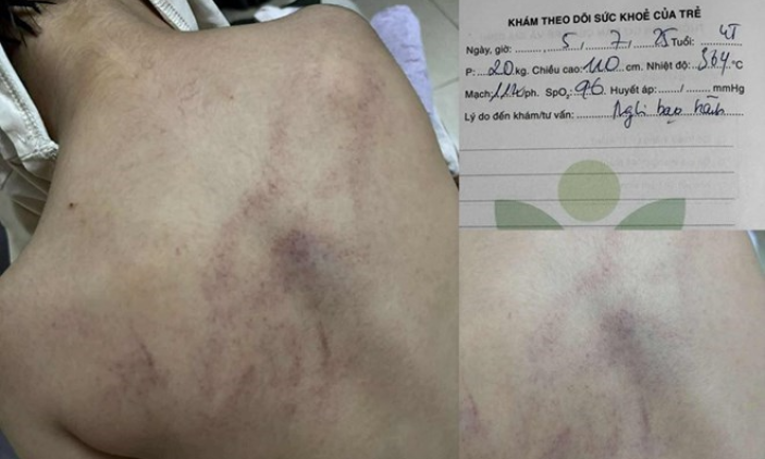 Vụ bé gái 4 tuổi bị đánh tím lưng: Đình chỉ thêm 1 giáo viên